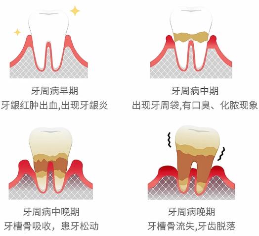 口腔健康警示：刷牙出血&ne;上火！牙周炎正在偷走你的全身健康